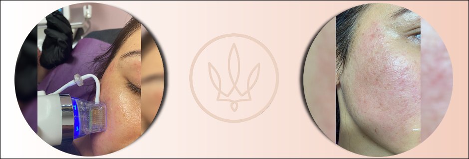 RF Microneedling